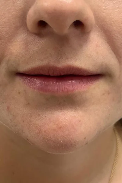 Antes — Labios con ácido hialurónico – antes y después