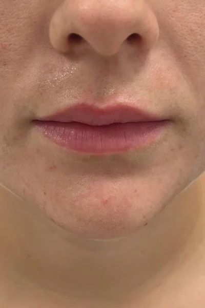 Después — Labios con ácido hialurónico – antes y después