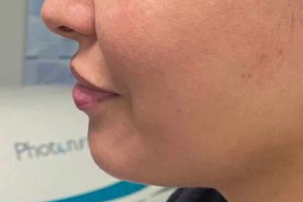 Before — Mentón, arco mandibular y labios con ácido hialurónico – antes y después