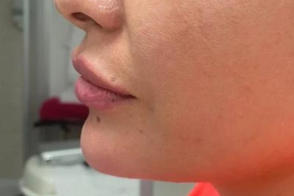 After — Mentón, arco mandibular y labios con ácido hialurónico – antes y después