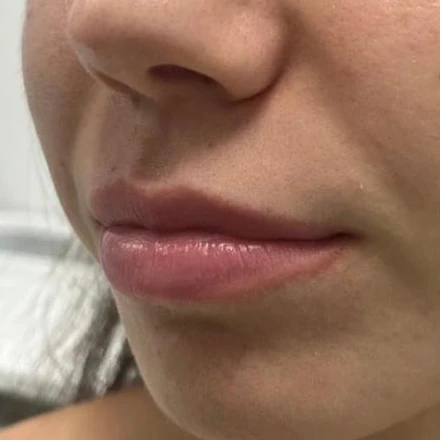 Before — Aumento de labios con ácido hialurónico – antes y después