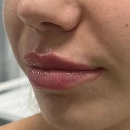 After — Aumento de labios con ácido hialurónico – antes y después