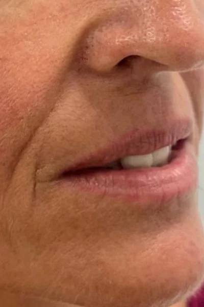 Before — Aumento de labios con ácido hialurónico – antes y después