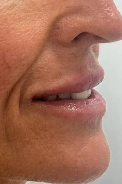 After — Aumento de labios con ácido hialurónico – antes y después