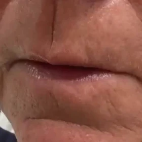Before — Aumento de labios con ácido hialurónico – antes y después