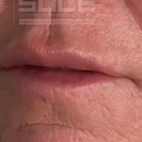 After — Aumento de labios con ácido hialurónico – antes y después