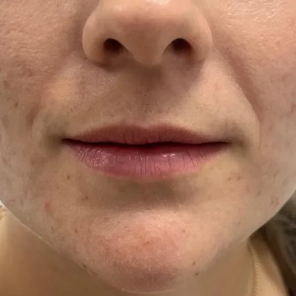 Before — Labios con ácido hialurónico – antes y después