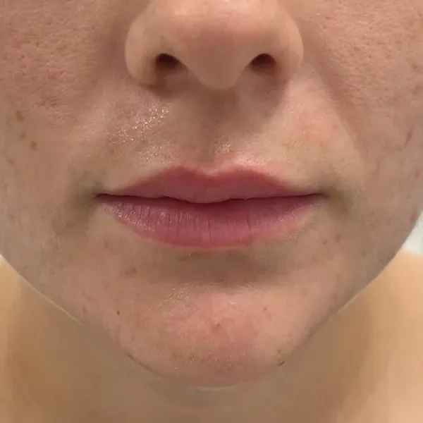 After — Labios con ácido hialurónico – antes y después