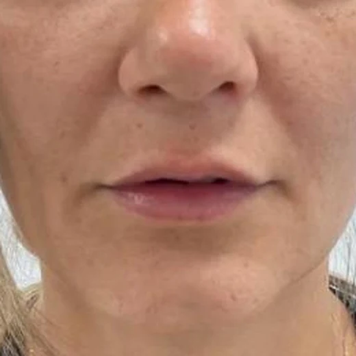 Before — Aumento de labios 1 - Antes