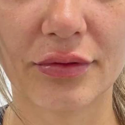 After — Aumento de labios 1 - Antes