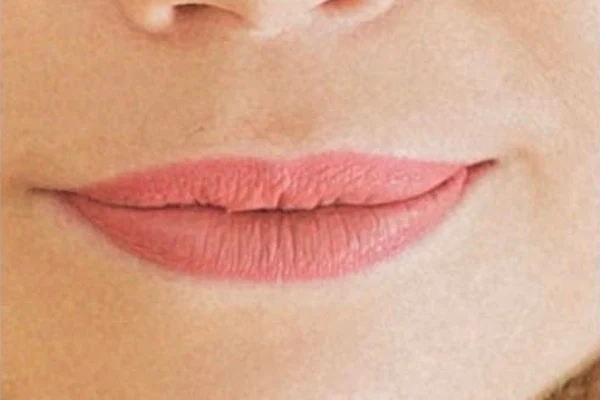 Before — Aumento de labios con ácido hialurónico – antes y después