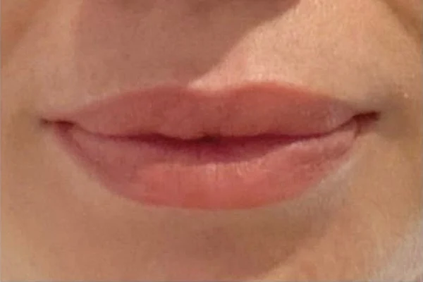 After — Aumento de labios con ácido hialurónico – antes y después