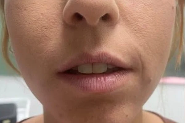 Before — Aumento de labios con ácido hialurónico – antes y después