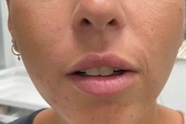 After — Aumento de labios con ácido hialurónico – antes y después