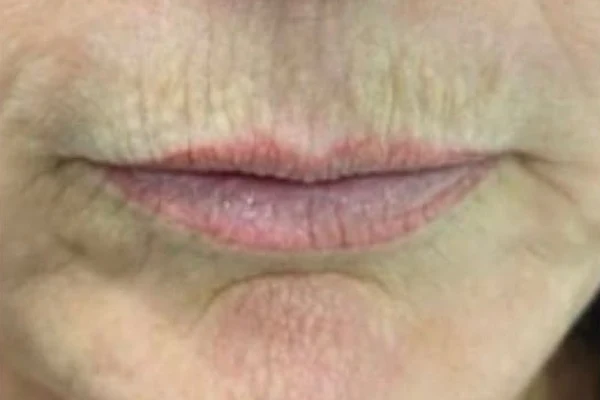 Before — Aumento de labios con ácido hialurónico – antes y después