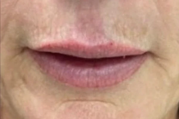 After — Aumento de labios con ácido hialurónico – antes y después