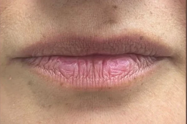 Before — Aumento de labios con ácido hialurónico – antes y después
