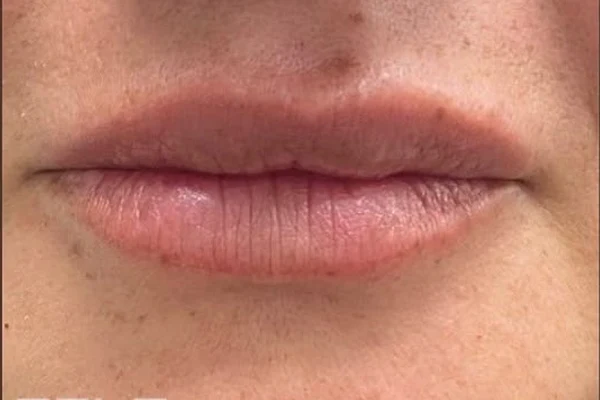 After — Aumento de labios con ácido hialurónico – antes y después
