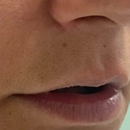 Before — Aumento de labios con ácido hialurónico – antes y después