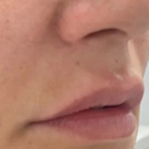After — Aumento de labios con ácido hialurónico – antes y después