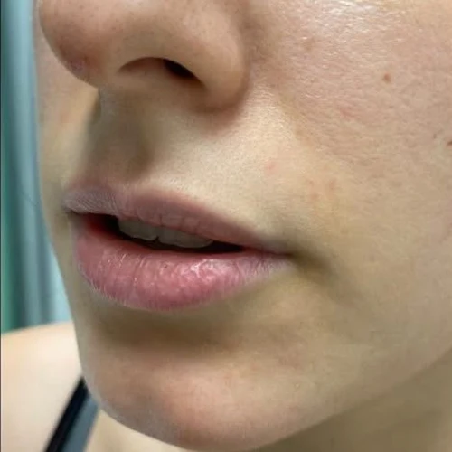 Before — Aumento de labios con ácido hialurónico – antes y después