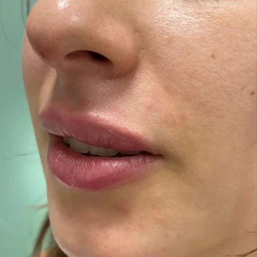 After — Aumento de labios con ácido hialurónico – antes y después