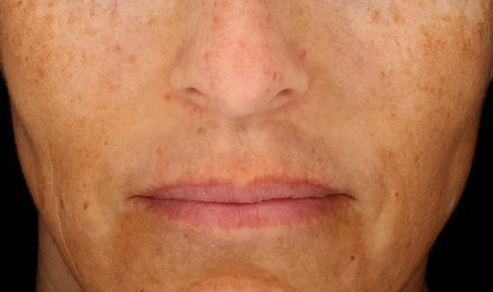 Antes — Cosmelan – manchas en mejillas y labio superior