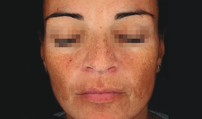 Antes — Cosmelan – manchas en el rostro