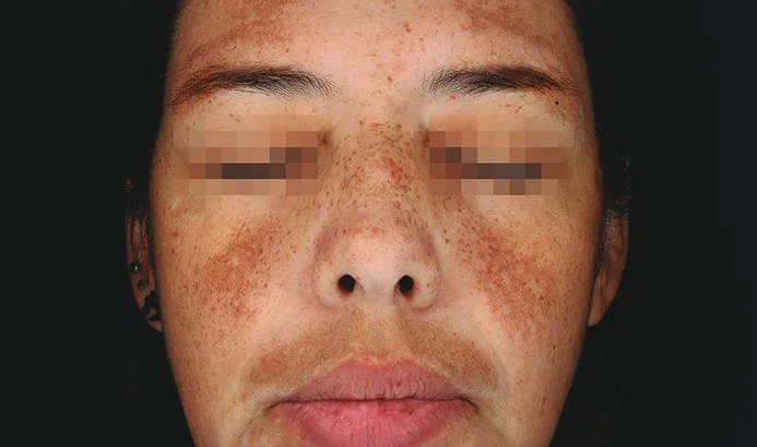 Antes — Cosmelan – manchas extensas en el rostro