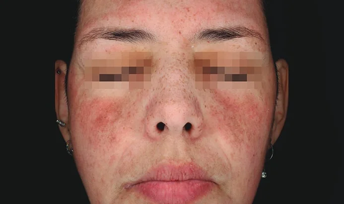 Después — Cosmelan – manchas extensas en el rostro