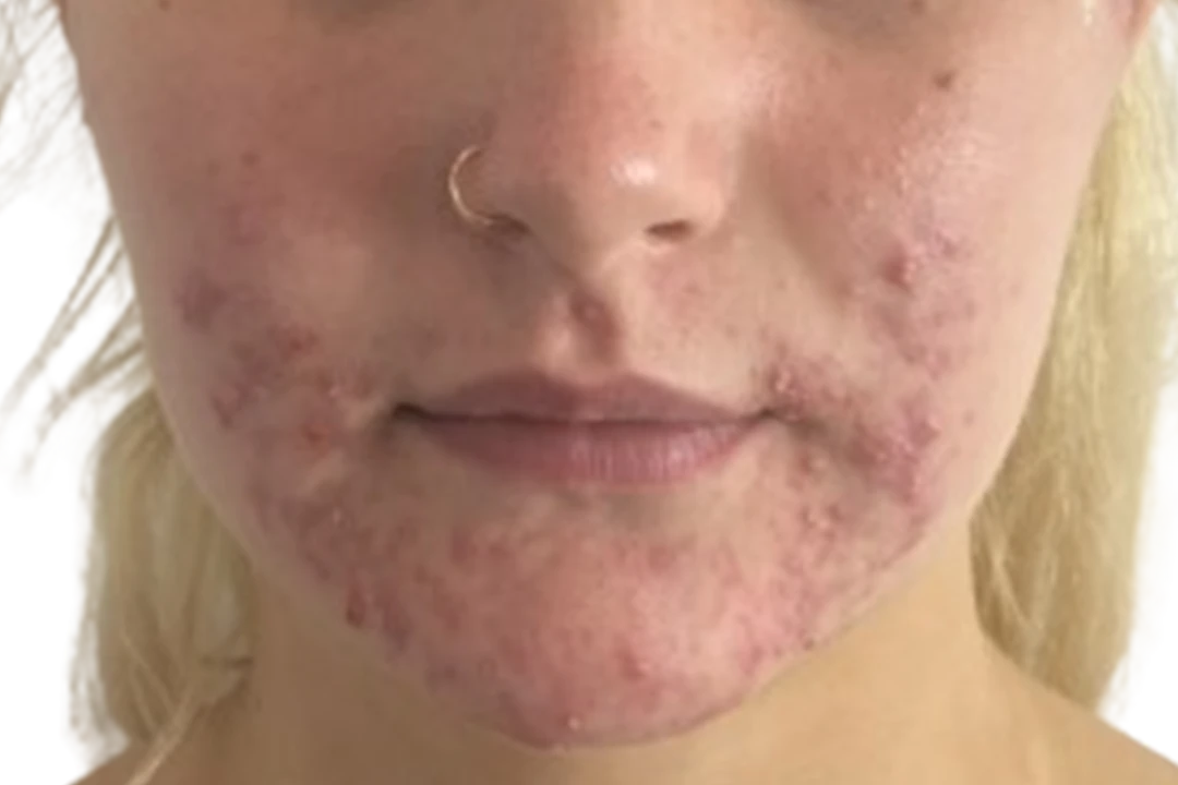 Voor — Dermapen 4 – Acné