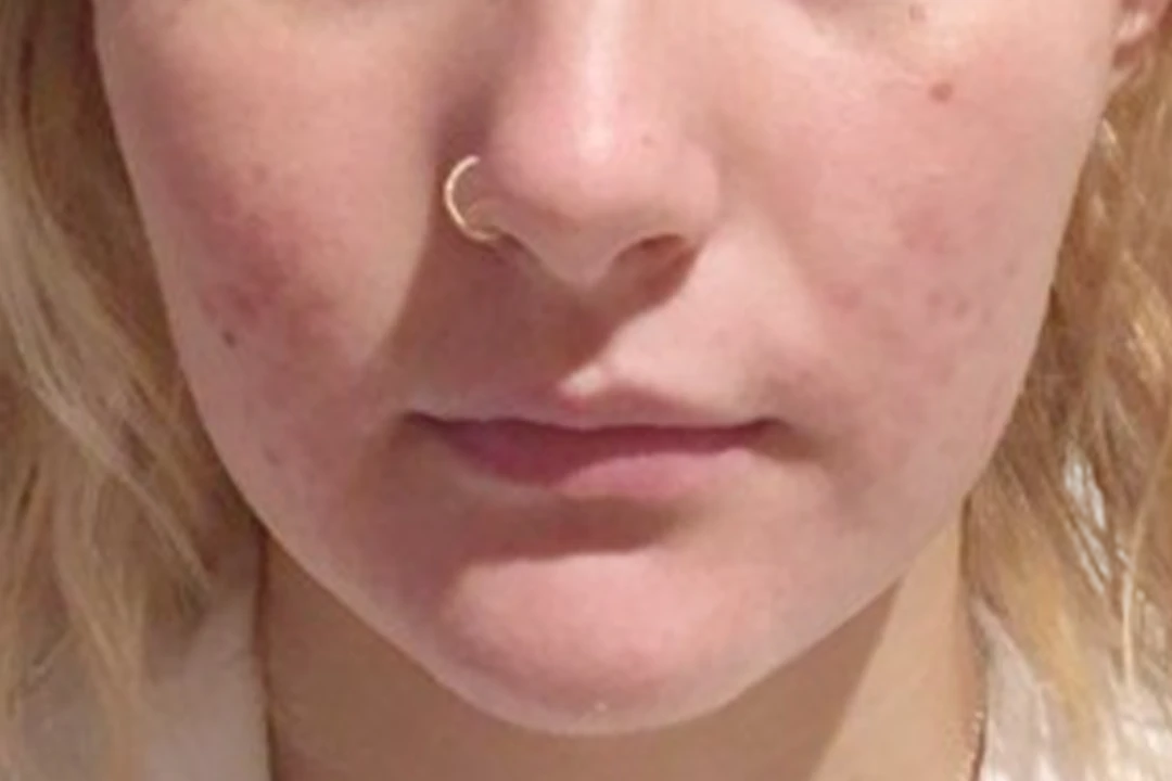 Na — Dermapen 4 – Acné