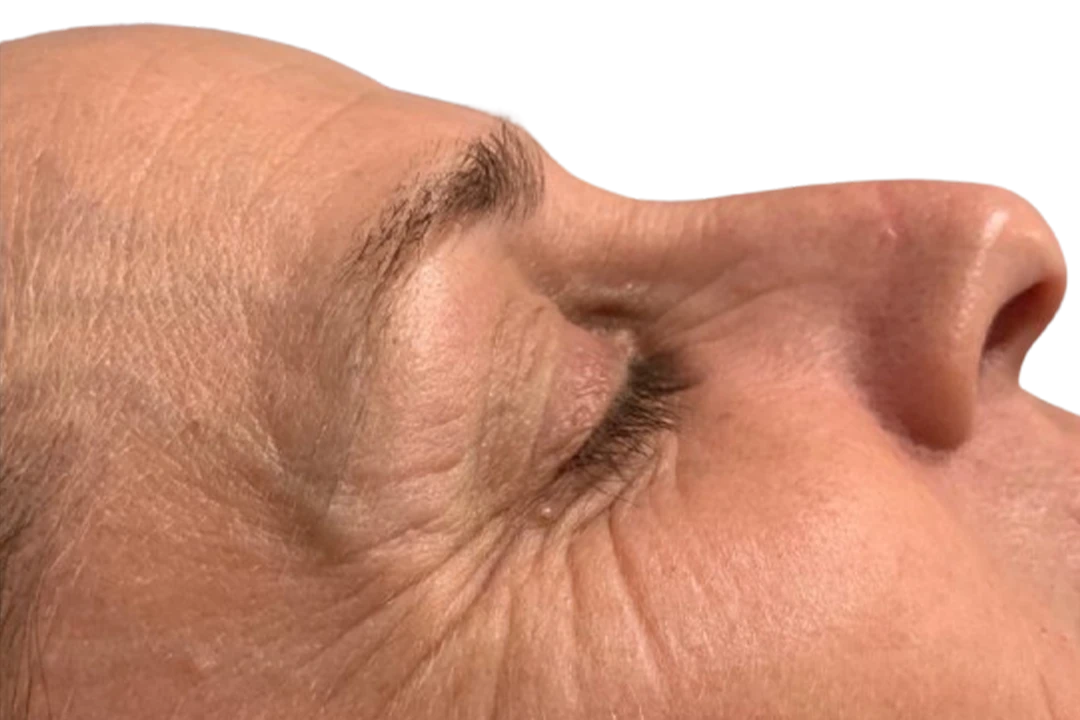 Voor — Dermapen 4 – Arrugas finas