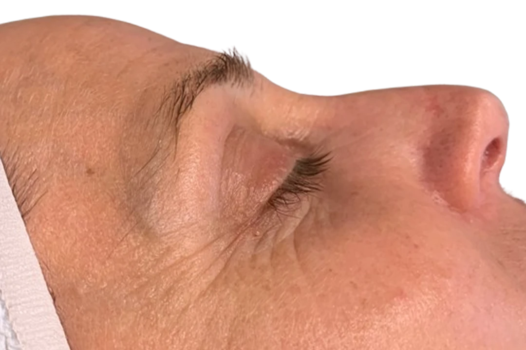 Na — Dermapen 4 – Arrugas finas