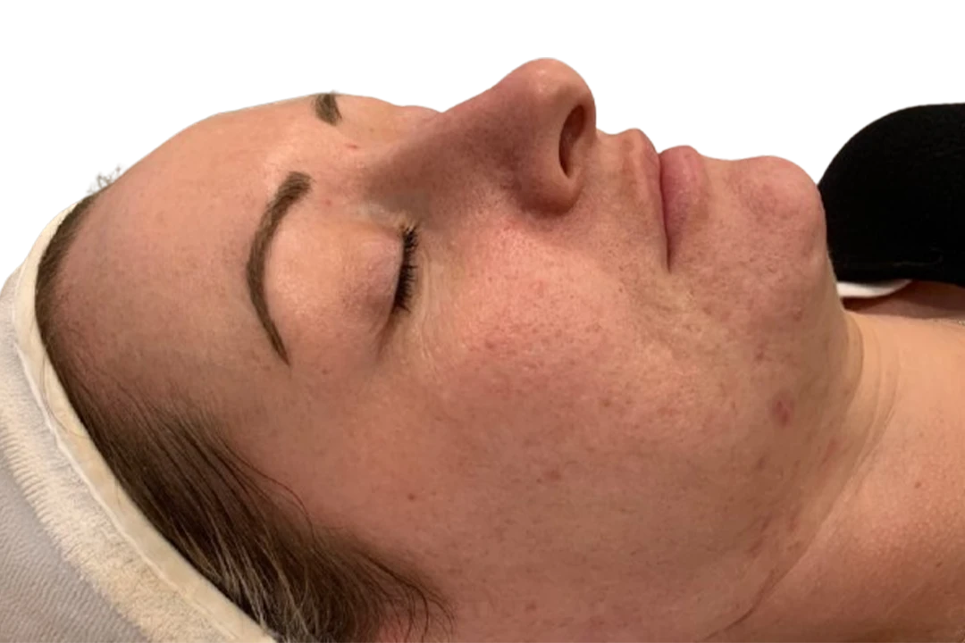 Voor — Dermapen 4 – Cicatrices