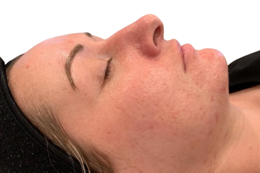 Na — Dermapen 4 – Cicatrices
