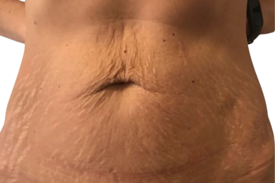 Voor — Dermapen 4 – Estrías