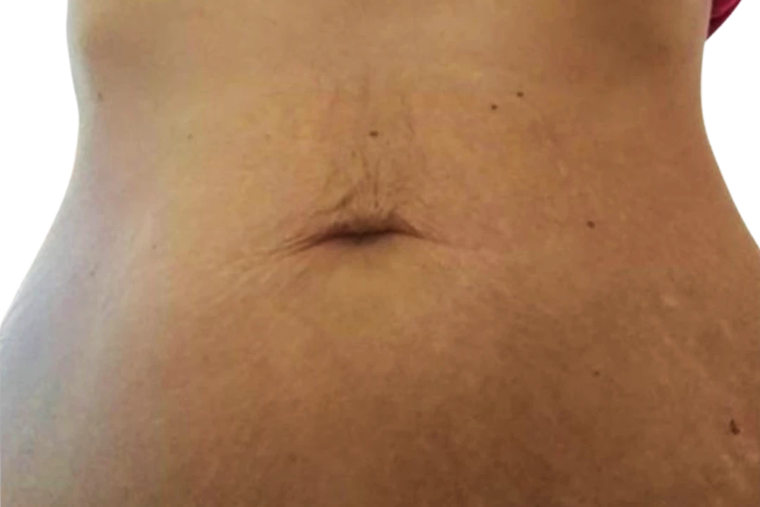 Na — Dermapen 4 – Estrías