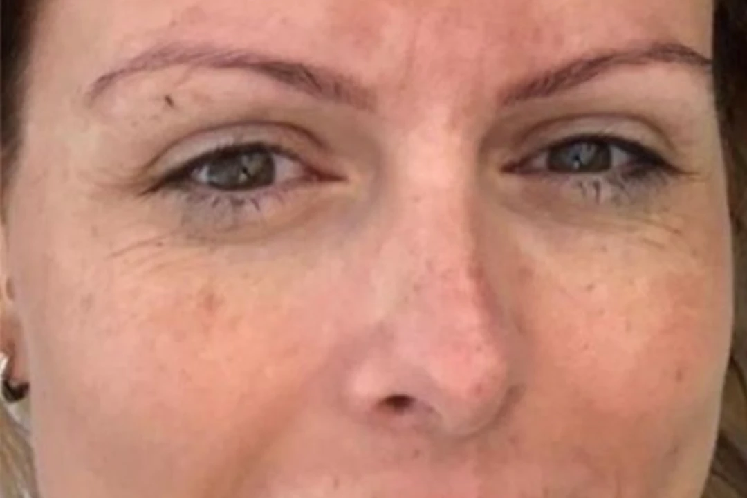 Voor — Dermapen 4 – Manchas