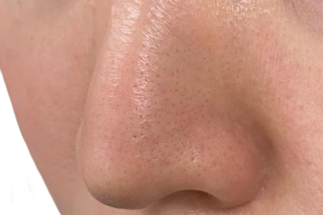 Na — Dermapen 4 – Poros dilatados