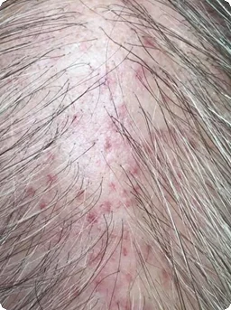Voor — Indiba capilar – prevención de la caída