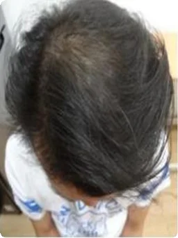 Voor — Indiba capilar – densidad del cabello