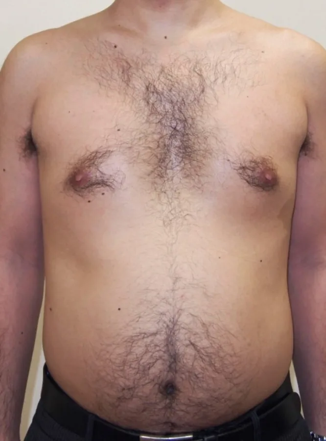 Antes — Radiofrecuencia corporal con Indiba – grasa localizada en abdomen