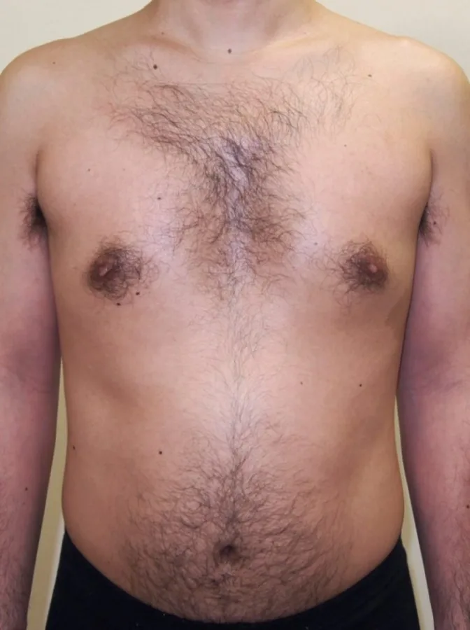 Después — Radiofrecuencia corporal con Indiba – grasa localizada en abdomen