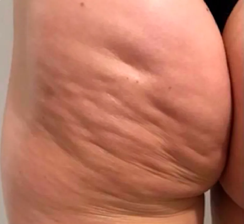 Antes — Radiofrecuencia corporal con Indiba – celulitis en glúteos