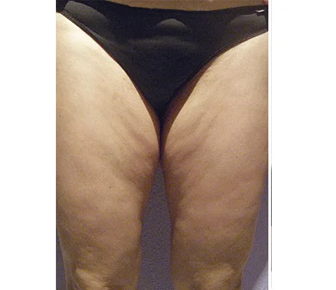 Antes — Radiofrecuencia corporal con Indiba – celulitis en muslos