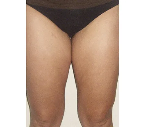 Después — Radiofrecuencia corporal con Indiba – celulitis en muslos
