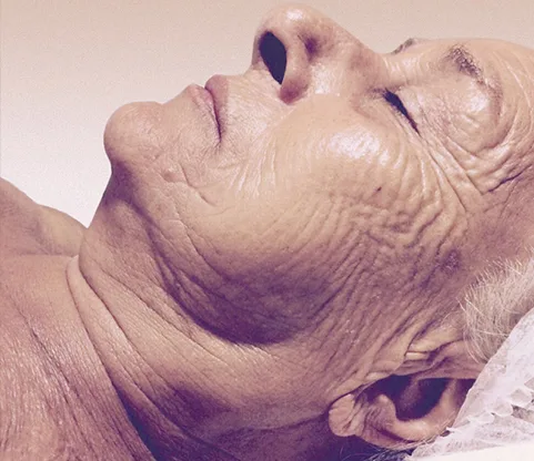 Antes — Indiba Facial – arrugas y líneas de expresión