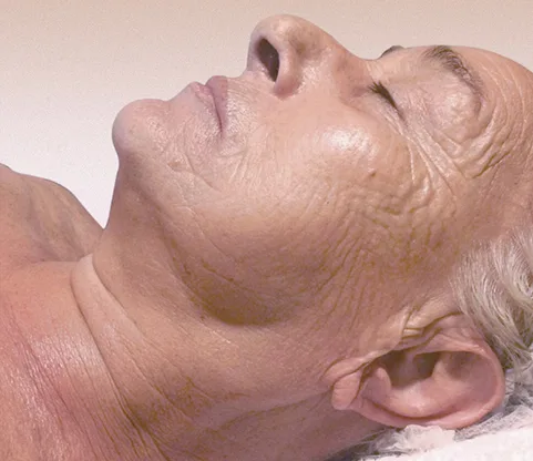 Después — Indiba Facial – arrugas y líneas de expresión