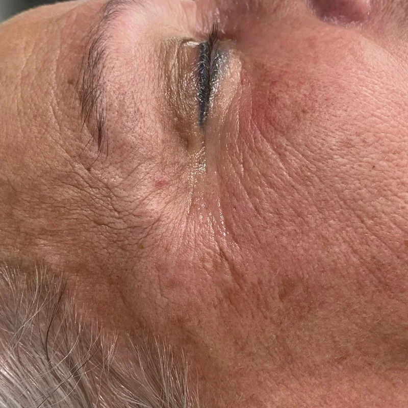 Antes — Indiba Facial en Sole Centro de Imagen – antes y después